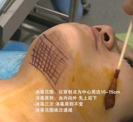 局部浸润麻醉视频,局部浸润麻醉操作步骤及要点解析